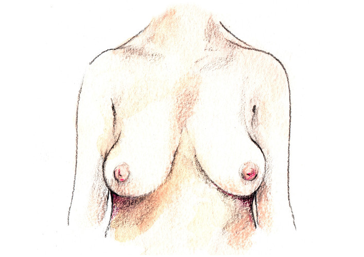 Cicatriu RECONSTRUCCIÓN