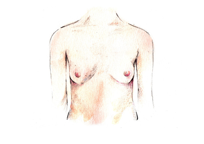 Cicatriu mastectomia