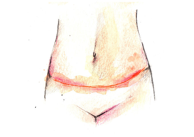 Cicatriu reconstrucció