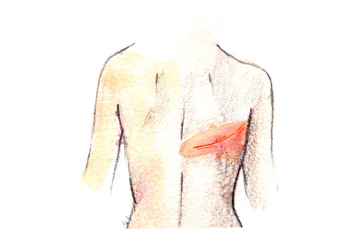 Cicatriu reconstrucció