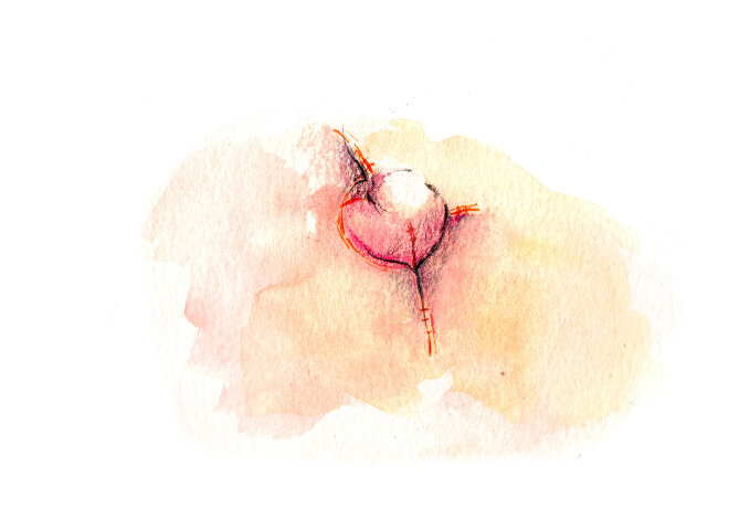 Reconstrucció mugró