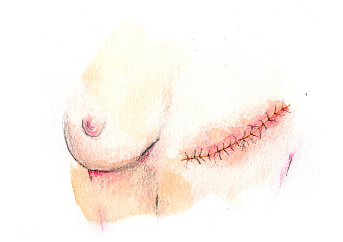 Cicatriu mastectomia